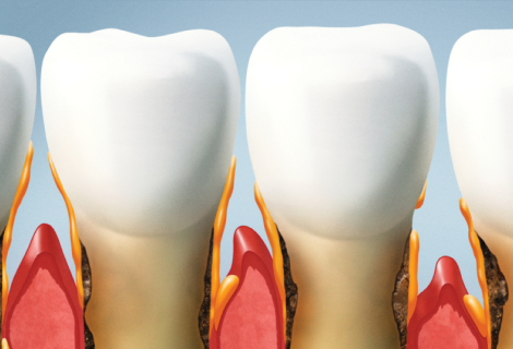 Gum Disease treatment in Rockledge Florida