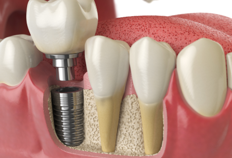 Types of Dental Implants: Finding the Best For your Teeth