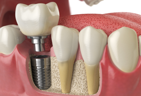 Dental Implants in Rockledge Florida, USA