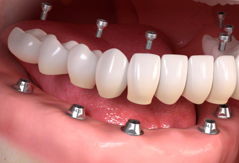 Multiple Teeth Implants - Smiles of Viera