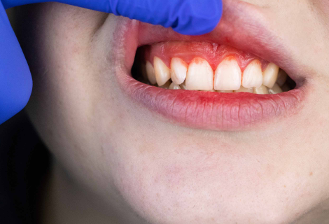 Bleeding Gums : Causes, Prevention