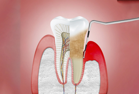 Periodontal Gum Disease Treatment