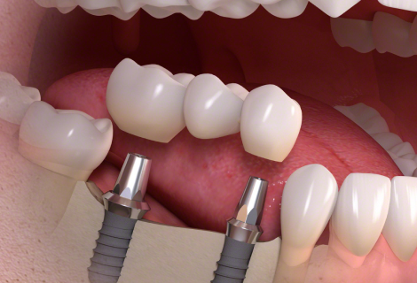 DENTAL BRIDGE in USA - Smiles of Viera (1)