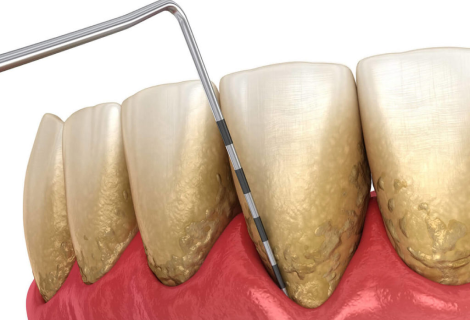 Periodontitis Testing Gum Recession Process