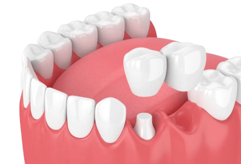 DENTAL BRIDGE - Smiles of Viera