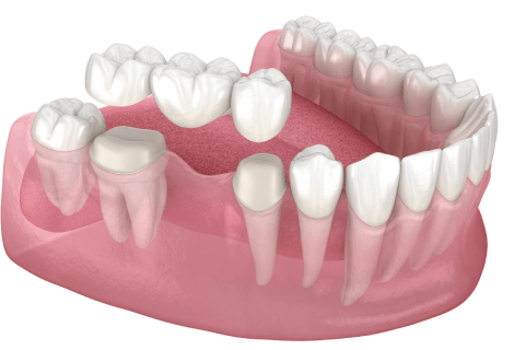 DENTAL BRIDGE in USA - Smiles of Viera