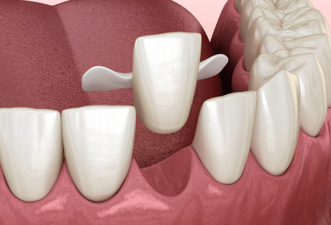 Affordable Dental Bridges in USA