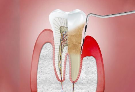 Root Canal Treatment - Smiles Of Viera