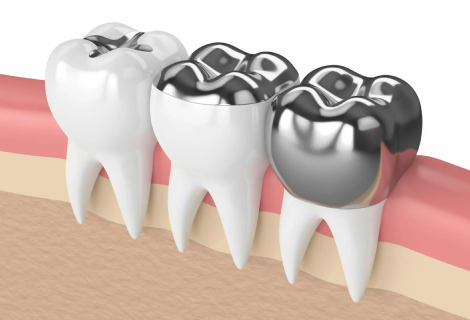 Dental Crowns, the Cost of Dental Crowns