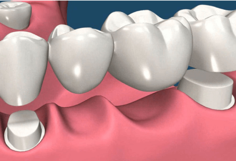 Dental Bridges in Rockledge