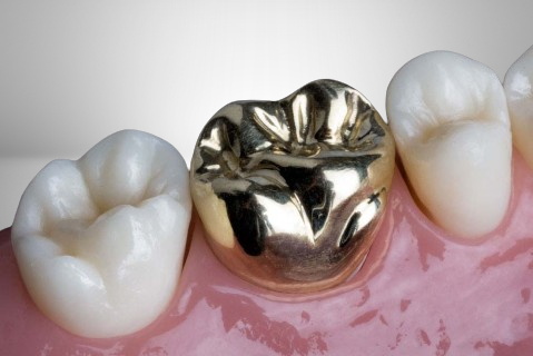 Dental Crowns For Teeth in Rockledge