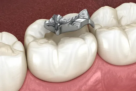 Tooth-Colored Fillings