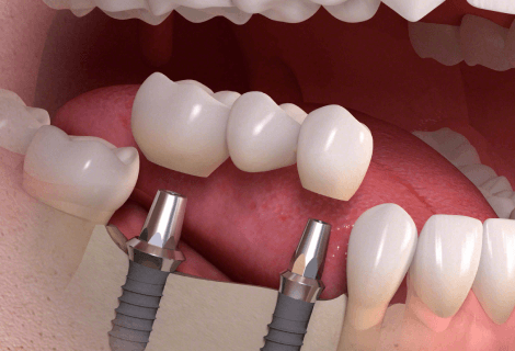 Cost Of Dental Implants In USA