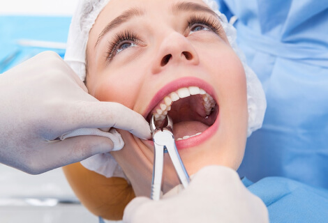 Tooth-Extractions