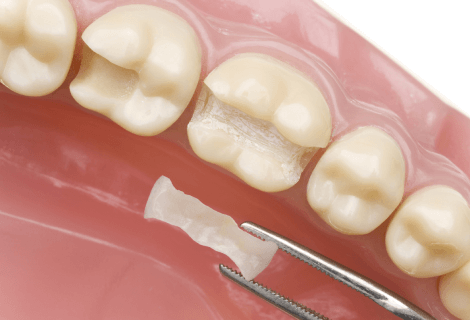 Ceramic inlays on the tooth