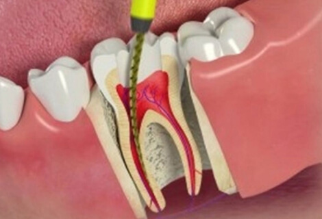 Root Canal Therapy at Smiles of Viera, fl