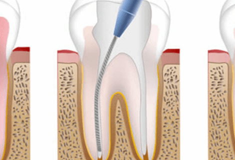 Root Canal Therapy at Smiles of Viera