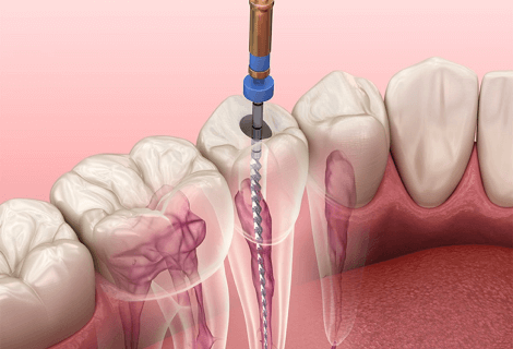 Root Canal Treatment in Rockledge Florida