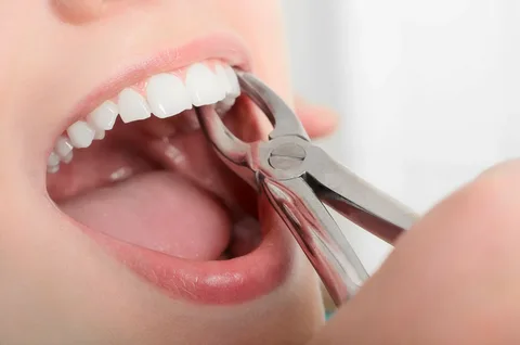 Tooth Extraction Surgery in Rockledge - 2