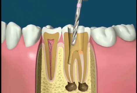 Root Canal Therapy Procedure