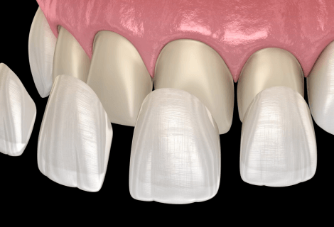 Veneers Treatment in Florida, USA