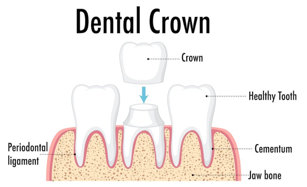 dental-crown-1024x624